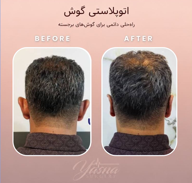 تفاوت اتوپلاستی برای کودکان و بزرگسالان