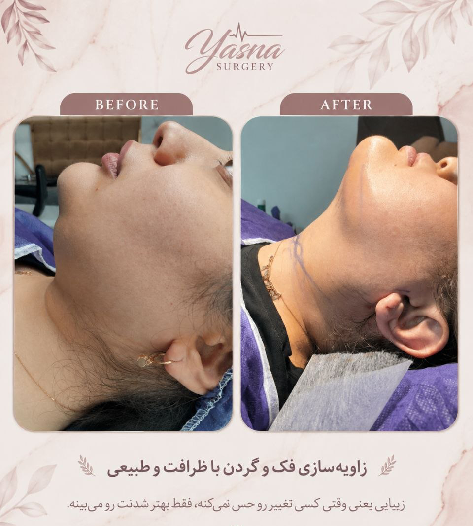 چه زمانی لیپو غبغب بعد از کاهش وزن لازم است؟
